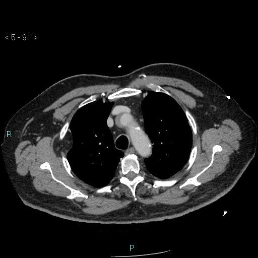 Aortic intramural hematoma (Radiopaedia 48463-53380 C 41).jpg