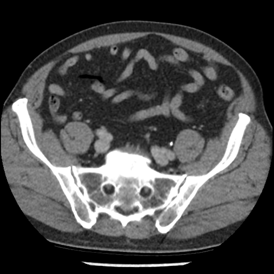 Aortic intramural hematoma (type B) (Radiopaedia 79323-92387 Axial C+ delayed 94).jpg