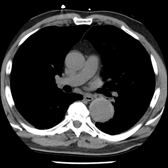 Aortic intramural hematoma (type B) (Radiopaedia 79323-92387 Axial non-contrast 24).jpg