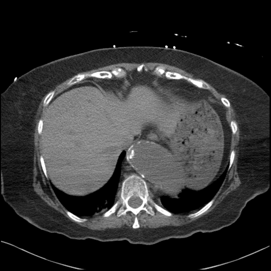 File:Aortic intramural hematoma with dissection and intramural blood pool (Radiopaedia 77373-89491 Axial non-contrast 82).jpg