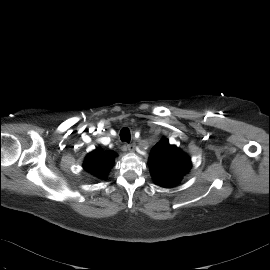 Aortic intramural hematoma with dissection and intramural blood pool (Radiopaedia 77373-89491 B 29).jpg