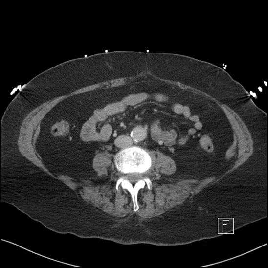 Aortic intramural hematoma with dissection and intramural blood pool (Radiopaedia 77373-89491 E 51).jpg