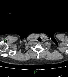 Aortic valve endocarditis (Radiopaedia 87209-103485 Axial non-contrast 5).jpg