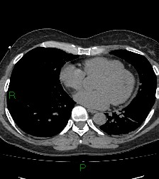 Aortic valve endocarditis (Radiopaedia 87209-103485 Axial non-contrast 65).jpg