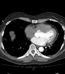 Aortic valve endocarditis (Radiopaedia 87209-103485 C 62).jpg