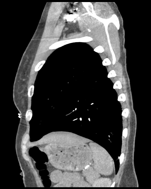 Aortic valve non-coronary cusp thrombus (Radiopaedia 55661-62189 D 11).png