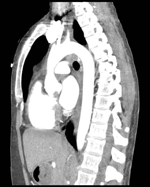 Aortic valve non-coronary cusp thrombus (Radiopaedia 55661-62189 D 27).png