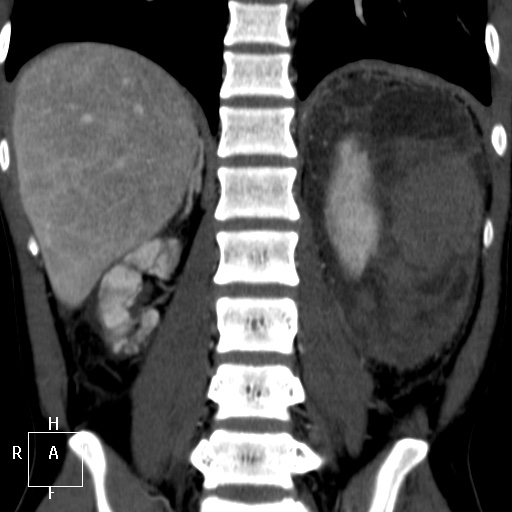 File:Aorto-left renal vein fistula (Radiopaedia 45534-49628 B 51).jpg