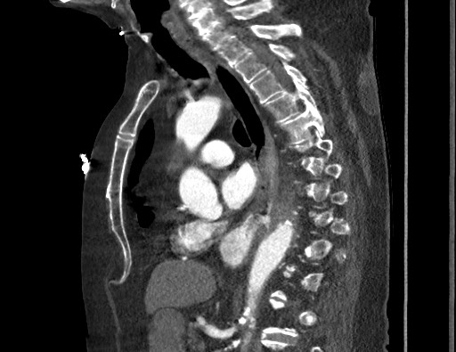 Aortoesophageal fistula with endovascular repair (Radiopaedia 73781-84592 Sagittal C+ CTPA 105).jpg