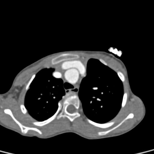 File:Aortopulmonary window, interrupted aortic arch and large PDA giving the descending aorta (Radiopaedia 35573-37074 B 22).jpg