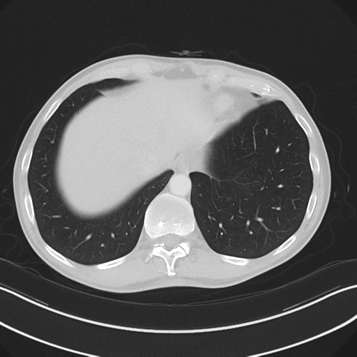 Apical pleural calcification (Radiopaedia 46141-50499 Axial lung window 59).png