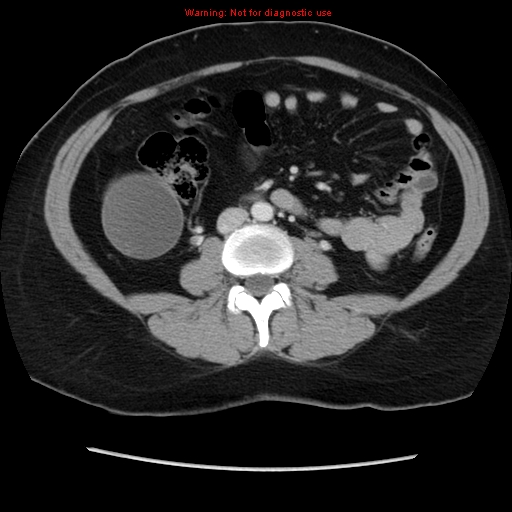 File:Appendiceal mucinous cystadenoma (Radiopaedia 8263-9111 Axial liver window 45).jpg