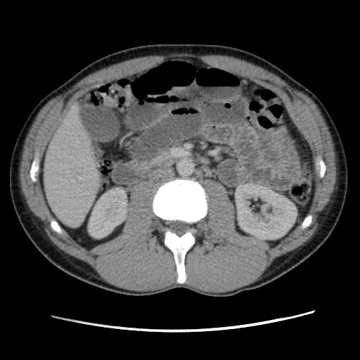 Appendicitis complicated by post-operative collection (Radiopaedia 35595-37114 A 38).jpg