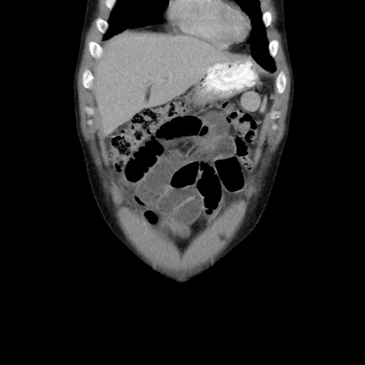 Appendicitis complicated by post-operative collection (Radiopaedia 35595-37114 B 13).jpg