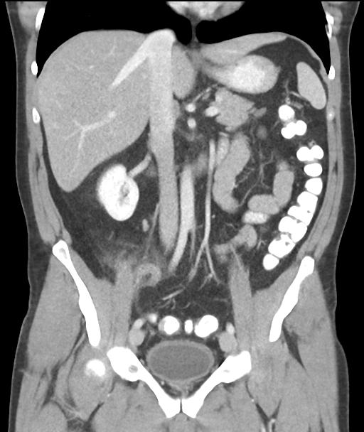Appendicitis with cecal bar sign (Radiopaedia 31878-32830 A 32).jpg