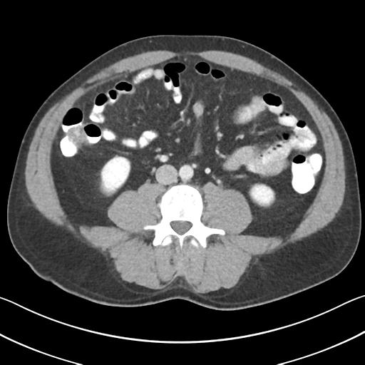 File:Appendicitis with cecal bar sign (Radiopaedia 31878-32830 B 45).jpg