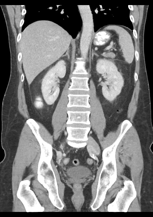 Appendicitis with thickening of the terminal ileum (Radiopaedia 42432-45550 B 37).png