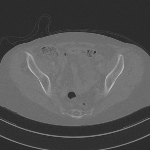 April fools' 2019- calcified peritoneal arachnoidosis (Radiopaedia 67273-76636 Axial bone window 44).png