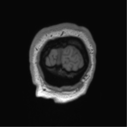 Arachnoid cyst with subdural hematoma (Radiopaedia 85892-101743 Coronal T1 2).png