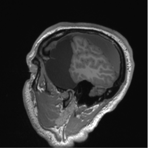 File:Arachnoid cyst with subdural hematoma (Radiopaedia 85892-101743 Sagittal T1 20).png