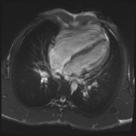 File:Arrhythmogenic right ventricular cardiomyopathy (Radiopaedia 57972-64966 A 16).jpg