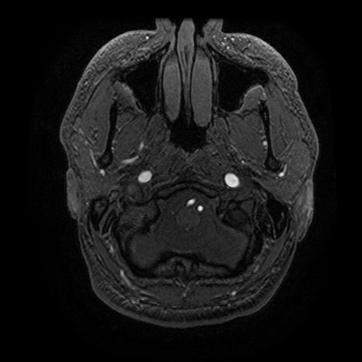 Arteriovenous malformation (Radiopaedia 71628-81999 Axial MRA 37).jpg