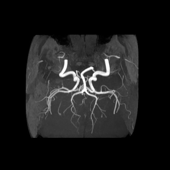 Artery of Percheron infarct (Radiopaedia 40966-43676 F 50).jpg