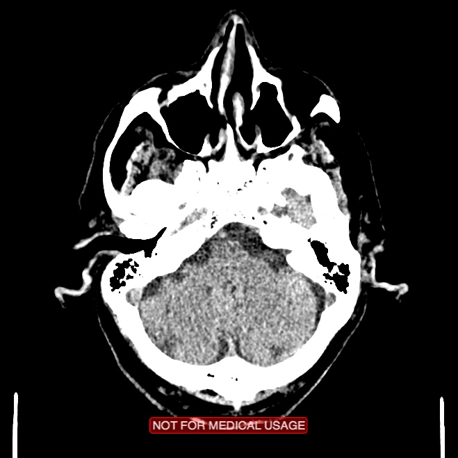 Artery of Percheron infarction (Radiopaedia 28679-28967 Axial non-contrast 26).jpg