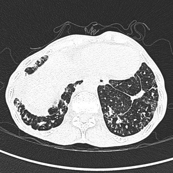 Aspergilloma- with Monod sign (Radiopaedia 44737-48532 Axial lung window 261).jpg