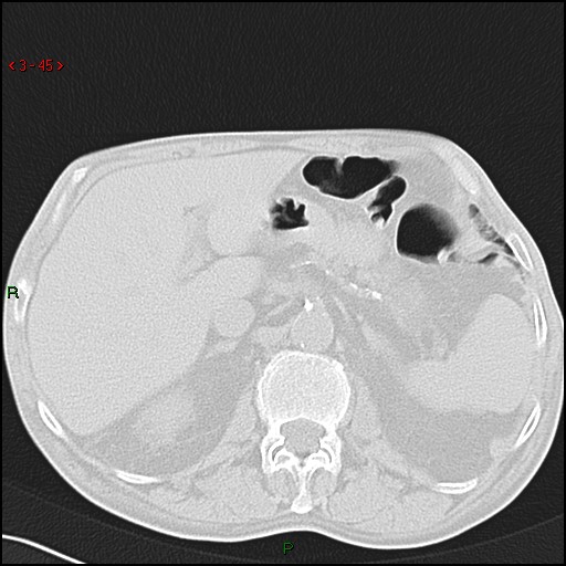 File:Aspergilloma (Radiopaedia 14842-14787 Axial lung window 45).jpg