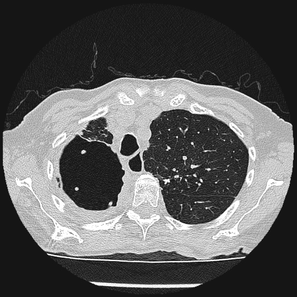 Aspergilloma (Radiopaedia 24458-24763 Axial lung window 14).jpg