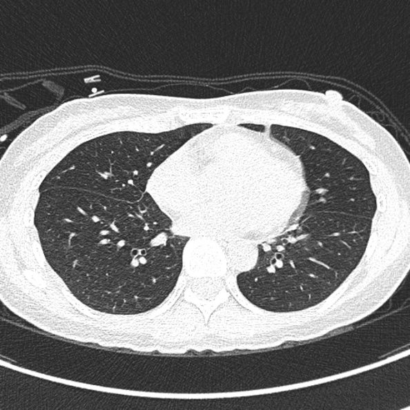 Aspergilloma (Radiopaedia 26223-26347 Axial lung window 48).jpg
