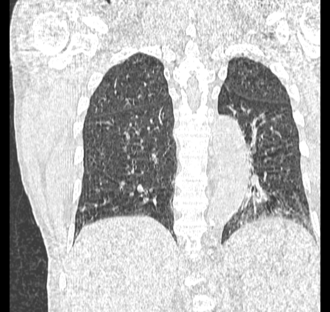 Aspergilloma (Radiopaedia 44592-48327 Coronal lung window 94).jpg