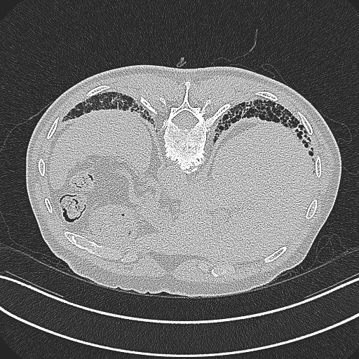 File:Aspergilloma on background pulmonary fibrosis (Radiopaedia 60942-68757 Axial lung window 33).jpg