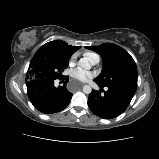 File:Aspiration pneumonia secondary to laparoscopic banding (Radiopaedia 18345-18183 A 27).jpg