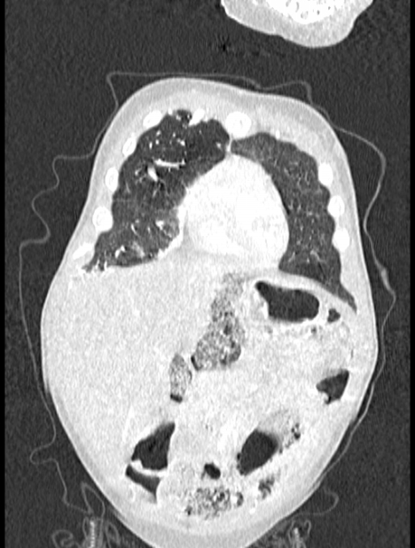 Asplenia syndrome (Radiopaedia 73083-83792 Coronal lung window 21).jpg