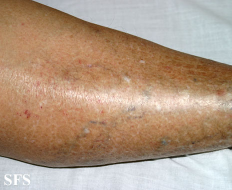 Asteatotic Dermatitis (Dermatology Atlas 1).jpg
