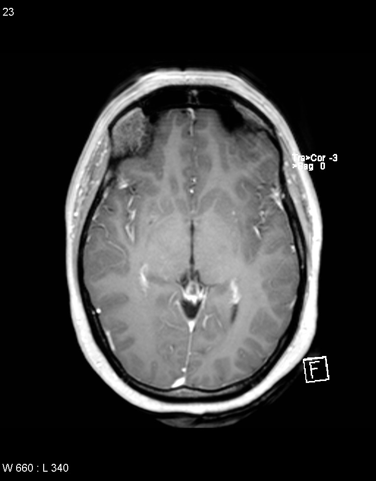 Astroblastoma (Radiopaedia 39792-42218 Axial T1 C+ 22).jpg
