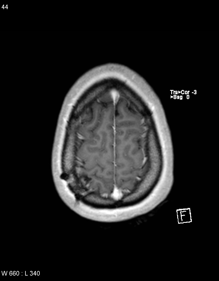Astroblastoma (Radiopaedia 39792-42218 Axial T1 C+ 43).jpg