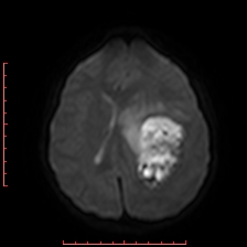 Astroblastoma (Radiopaedia 74287-85162 Axial DWI 61).jpg