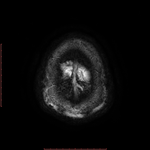 Astrocytoma NOS - cystic (Radiopaedia 59089-66384 Axial SWI 70).jpg