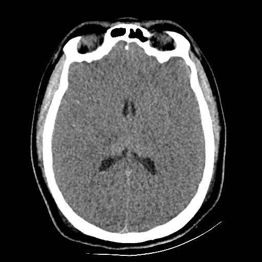 Atlanto-occipital dislocation (Radiopaedia 44648-48412 Axial non-contrast 30).jpg