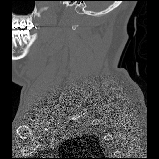 Atlanto-occipital dissociation injury (Radiopaedia 29274-29698 Sagittal bone window 10).png