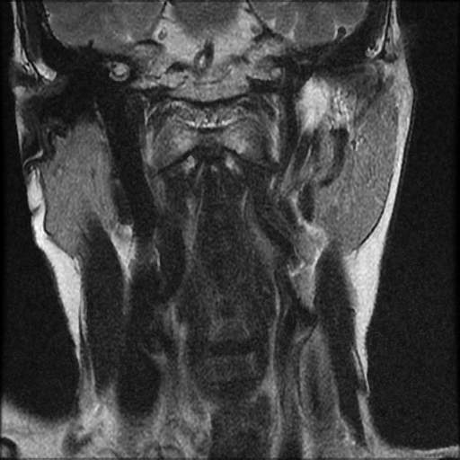 File:Atlantoaxial subluxation - rheumatoid arthritis (Radiopaedia 63564-72199 Coronal T2 6).jpg