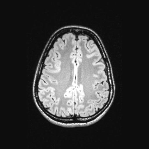 Atretic encephalocoele with inferior vermis hypoplasia (Radiopaedia 30443-31108 Axial 114).jpg