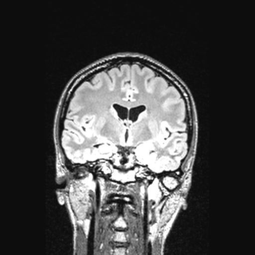 Atretic encephalocoele with inferior vermis hypoplasia (Radiopaedia 30443-31108 Coronal FLAIR 101).jpg