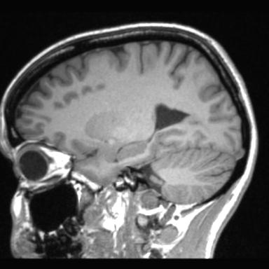 Atretic encephalocoele with inferior vermis hypoplasia (Radiopaedia 30443-31108 Sagittal T1 90).jpg
