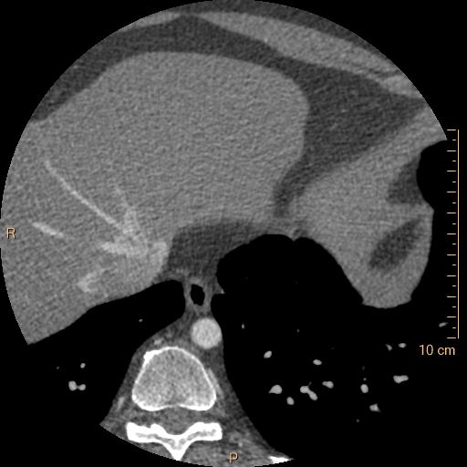 Atrial septal defect (upper sinus venosus type) with partial anomalous pulmonary venous return into superior vena cava (Radiopaedia 73228-83961 A 257).jpg