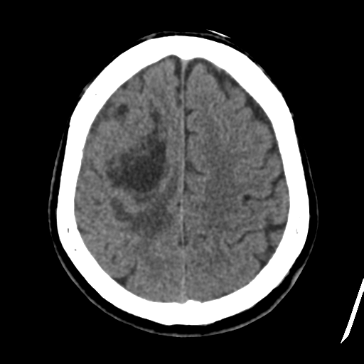 File:Atypical meningioma (WHO grade II) with osseous invasion (Radiopaedia 53654-59715 Axial non-contrast 40).png