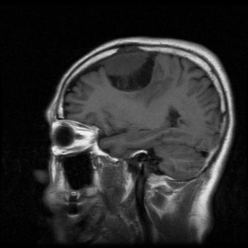 File:Atypical meningioma with skull invasion (Radiopaedia 34357-35648 Sagittal T1 16).png